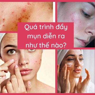 Đẩy mụn là gì? Quá trình đẩy mụn diễn ra như thế nào