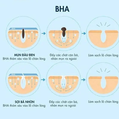 Dùng BHA bị đẩy mụn phải làm sao hồi phục nhanh nhất?