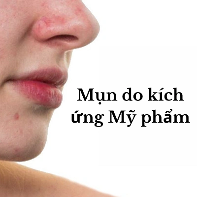 Hiện tượng mụn kích ứng mỹ phẩm và giải pháp điều trị hiệu quả