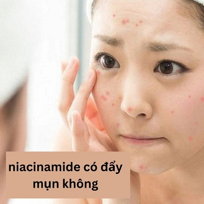 Niacinamide có đẩy mụn không? Lý giải hiện tượng từ chuyên gia