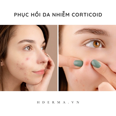 Phục hồi da nhiễm corticoid: Hướng dẫn chuyên sâu từng bước