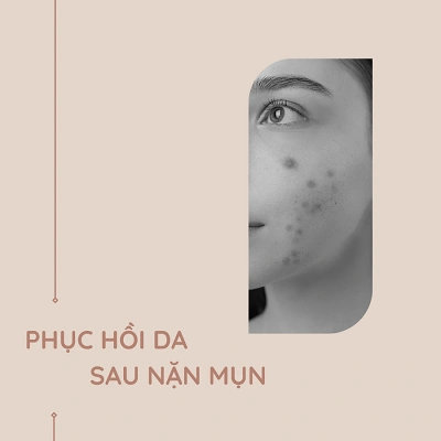 6 bước phục hồi da sau nặn mụn cần làm ngay tránh để lại sẹo