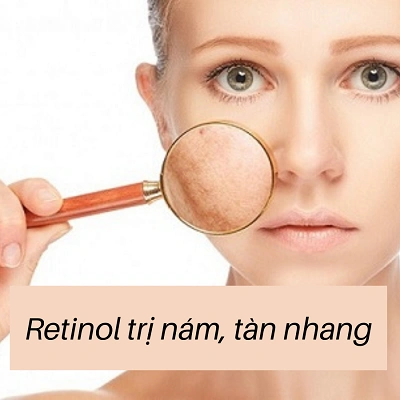 Hướng dẫn sử dụng Retinol trị nám, tàn nhang an toàn và hiệu quả